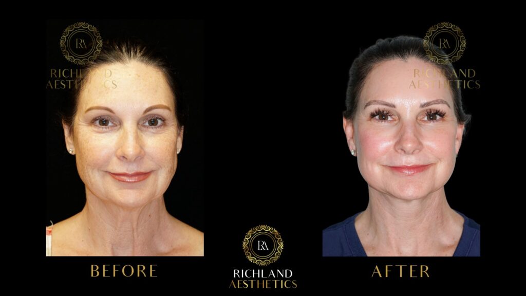 Chemical-Peels-Before-and-After-Face-and-Neck-Front-01
