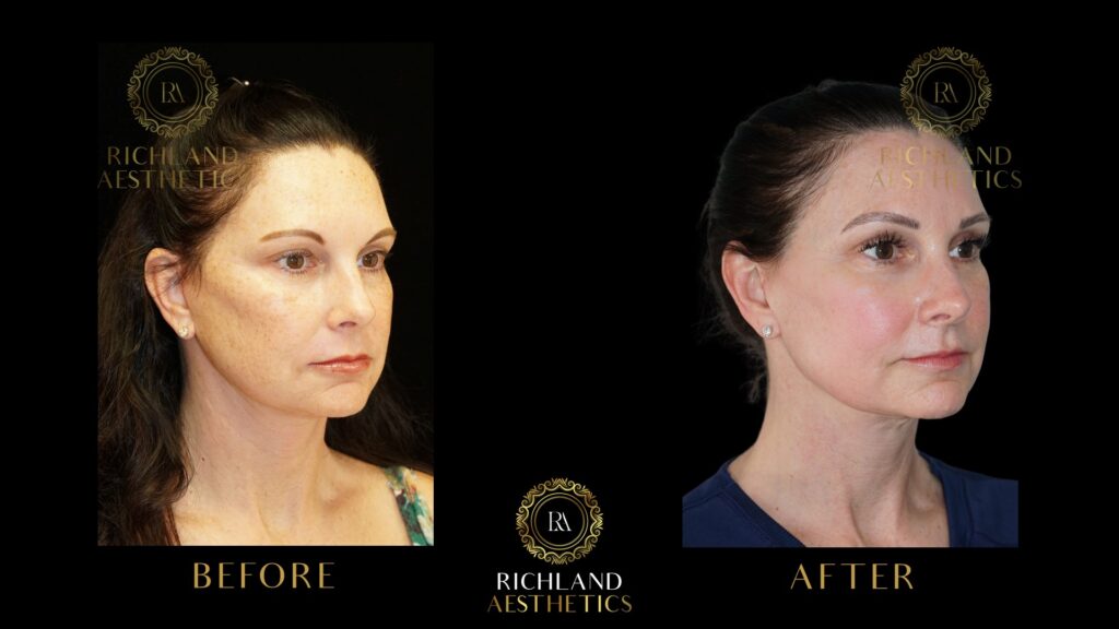 Chemical-Peels-Before-and-After-Face-and-Neck-Side1-01