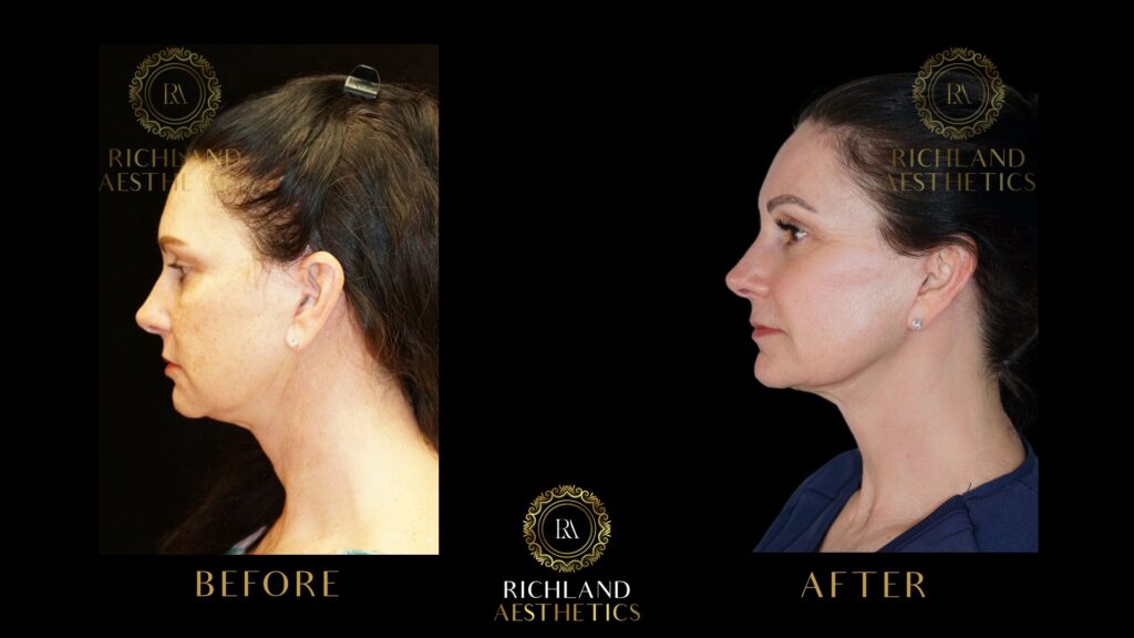 Chemical-Peels-Before-and-After-Face-and-Neck-Side2-01