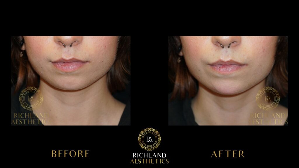 Juvederm-Before-and-After-Chin-Front-01