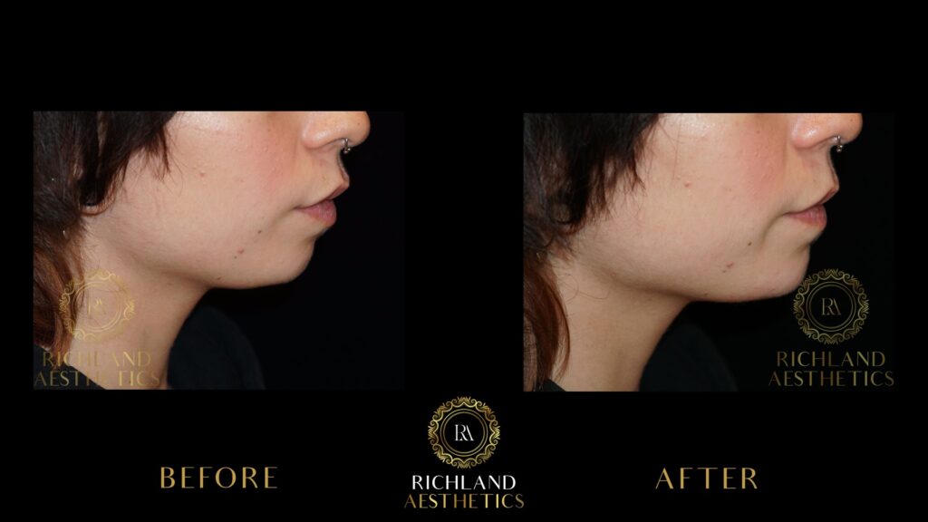 Juvederm-Before-and-After-Chin-Side1-01