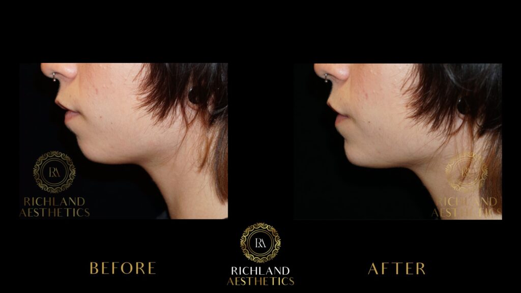 Juvederm-Before-and-After-Chin-Side2-01
