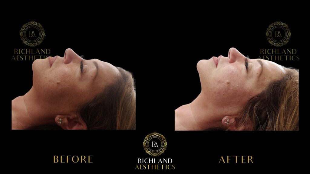 PDO-Thread-Lift-Before-and-After-Jowels-and-Neckline-left-01