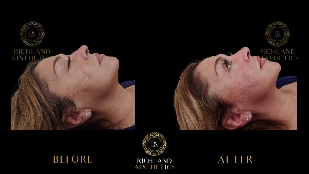 PDO-Thread-Lift-Before-and-After-Jowels-and-Neckline-right-01