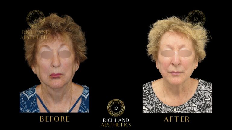 Morpheus8-Before-&-After-See-Stunning-Results-Richland-Aesthetics-3